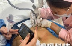 妊娠紋用什么儀器能去除？妊娠紋修復儀器廠家_最新祛妊娠紋的儀器